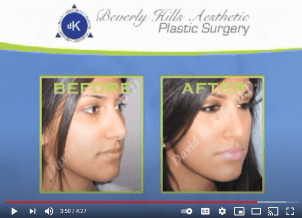 Best Rhinoplasty Beverly Hills Nose Surgery Specialist Drs Kim
