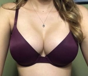 Umbilical Breast Augmentation to go Larger - Dr. Kim Los Angeles